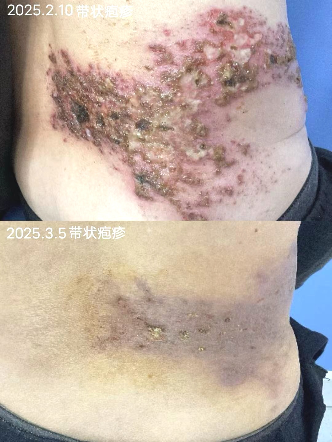 【和平皮肤】带状疱疹：你需要知道的那些事
